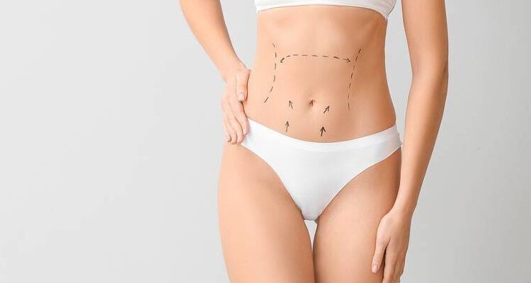 ABDOMINOPLASTIA