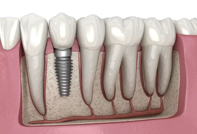 GUÍA SOBRE IMPLANTES DENTALES